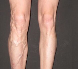Varicosis progresses quickly