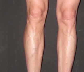 Veniselle helped to get rid of varicose veins