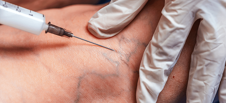 Sclerotherapy is a procedure that eliminates varicose veins