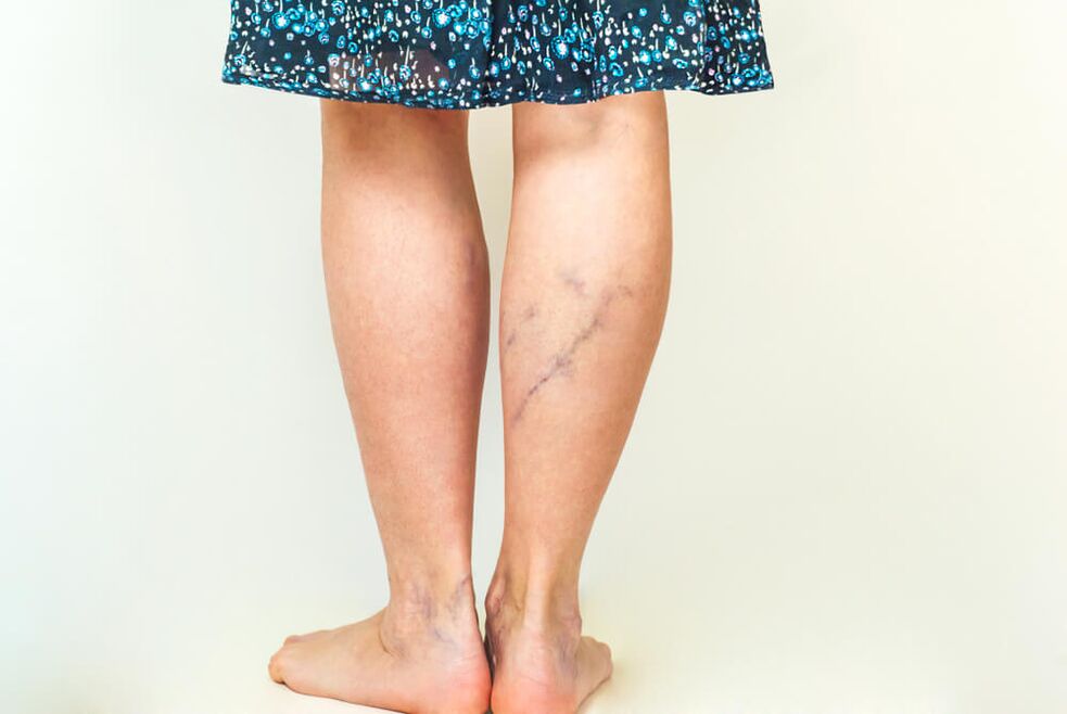 Varicose veins of the lower extremities in a woman