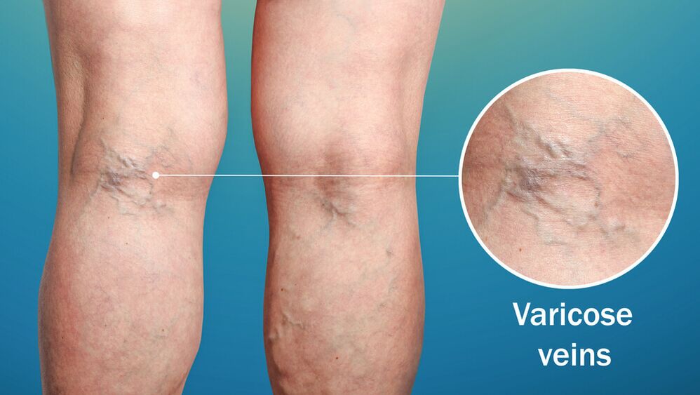 Varicose veins on the legs