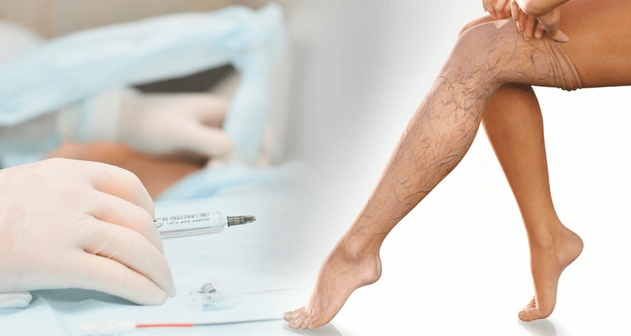 Treatment of varicose veins