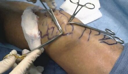 Surgery for varicose veins