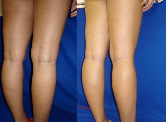 Internal causes of varicose veins