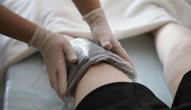 Folk methods of treating varicose veins in women