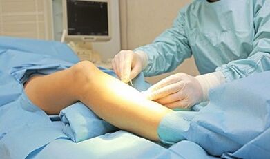 Operational methods for treating varicose veins in women