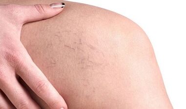 how varicose veins in women manifest