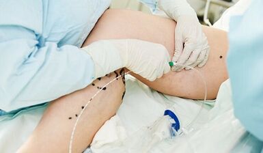 Methods for the treatment of varicose veins on the legs in women