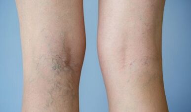 Signs of varicose veins on the legs in women