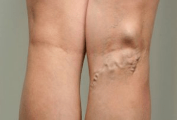 Diagnosis of varicose veins in pregnant women