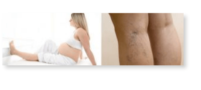 recommendations for varicose veins in pregnant women