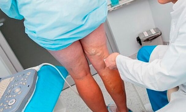 Diagnosis of varicose veins of the legs