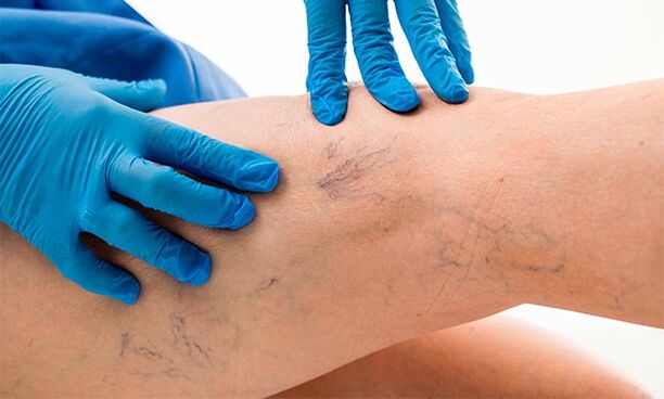 Varicose veins