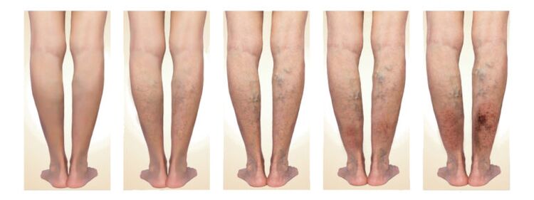 symptoms of varicose veins