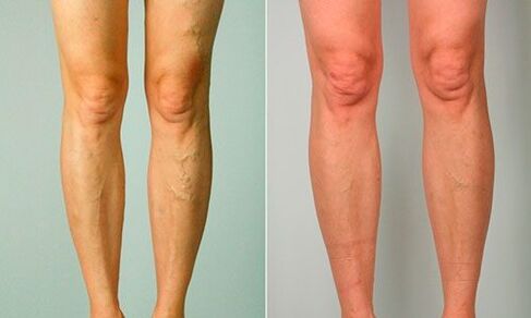 before and after treatment for varicose veins