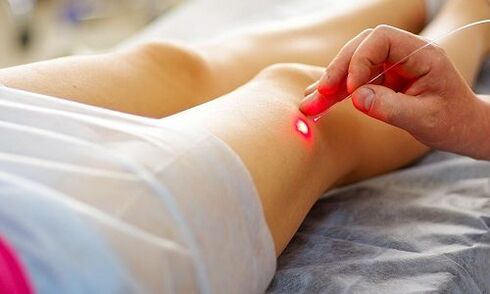 laser therapy as a method of treating varicose veins