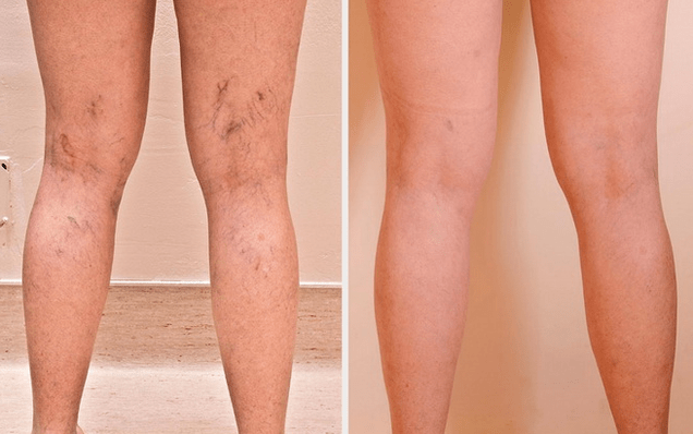 legs before and after treatment for varicose veins