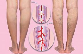 varicose veins of the lower extremities
