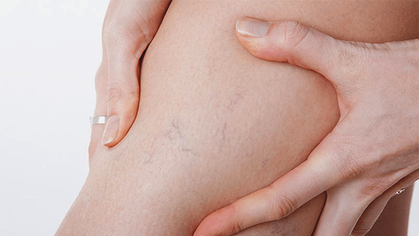 varicose veins on legs
