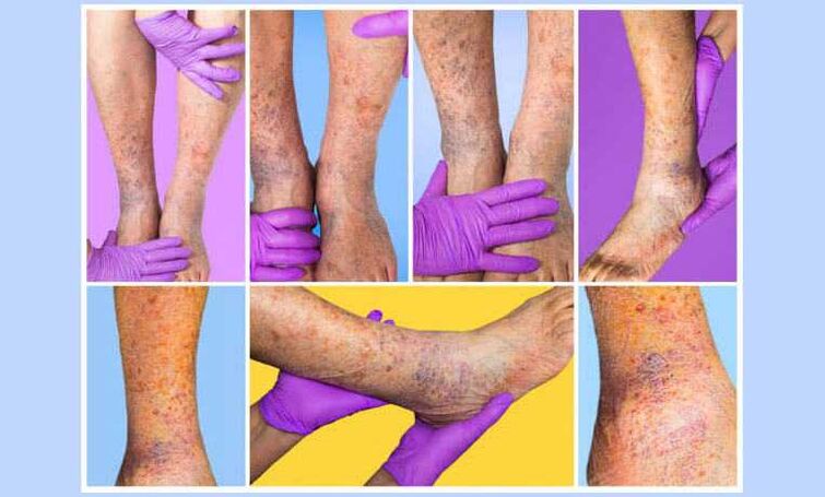 A phlebologist examines the lower extremities of a patient with varicose veins