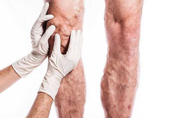 Palpation of varicose veins on the legs