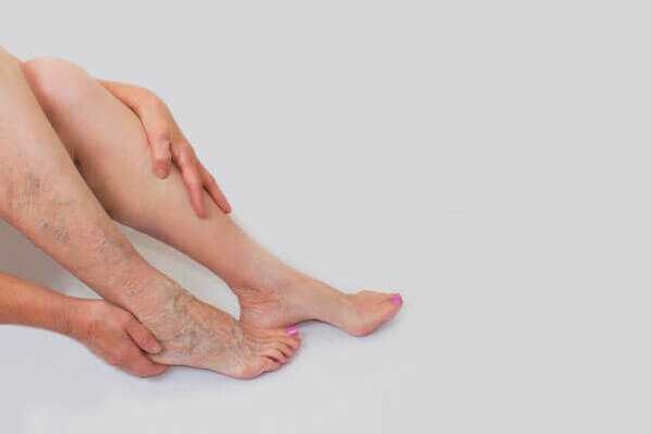 Protruding dilated veins are a sign of varicose veins of the lower extremities