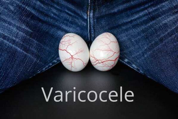 Varicocele - dilation of the veins of the spermatic cord
